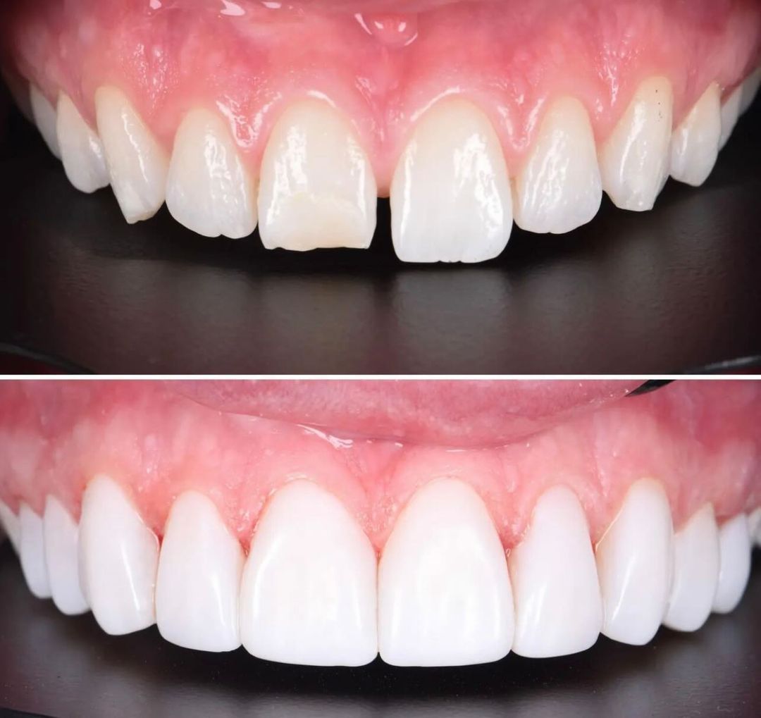Woman spends £4,000 on new teeth after a decade of insecurity – but ...