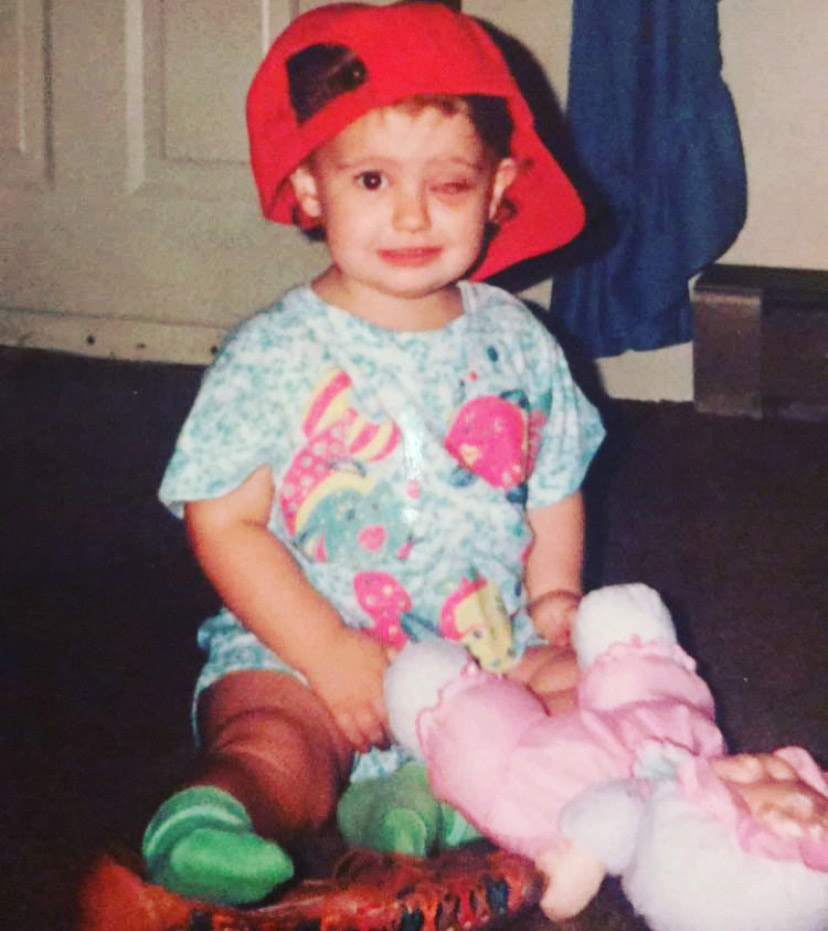 Rachel as a baby with a swollen eye following surgery