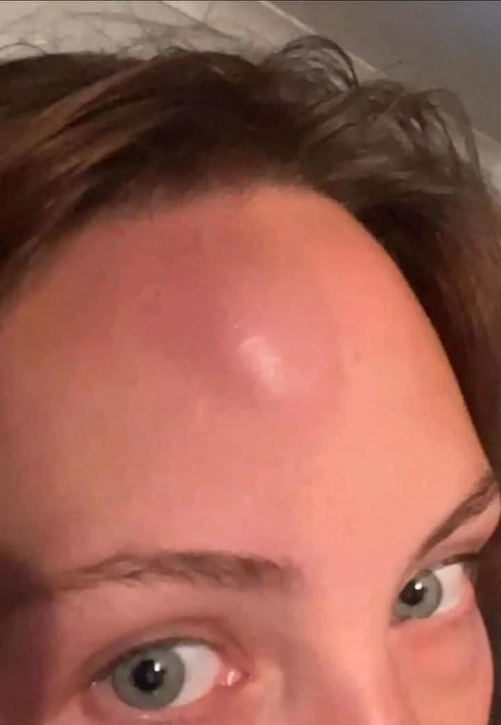 Emma’s ‘mysterious golf ball sized lump’ on her forehead.