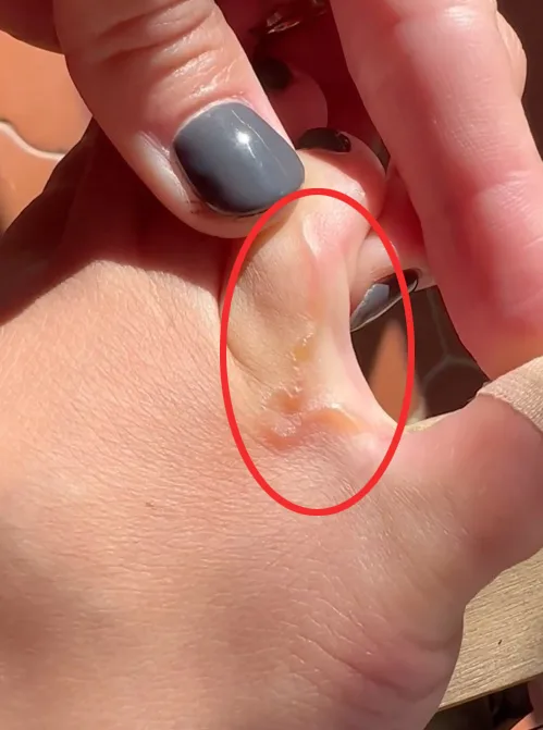 Video grab of the parasitic worm in Lucía Pombo’s toe after returning from her dream holiday.