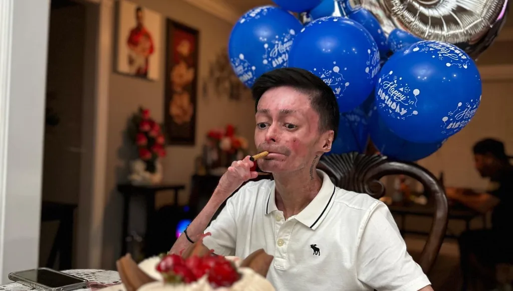 Victor Hugo Quiroz the man with one of the rarest skin conditions having difficulty eating.
