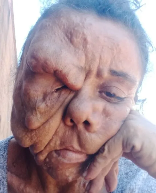 the mum from brazil suffering from rare facial deformity desperate for cosmetic surgery.