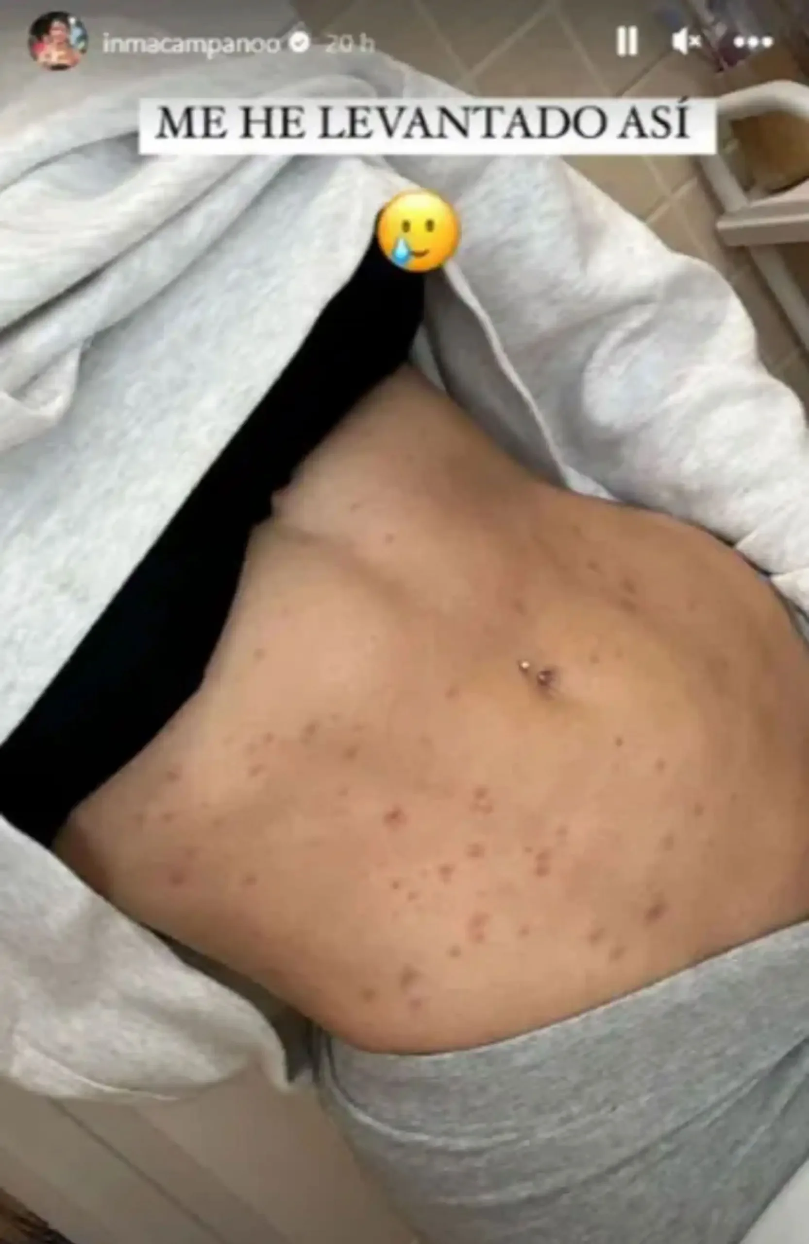 the influencer Inma Campano's showing her belly rash, after getting influenza A, scarlet fever and scabies at same time