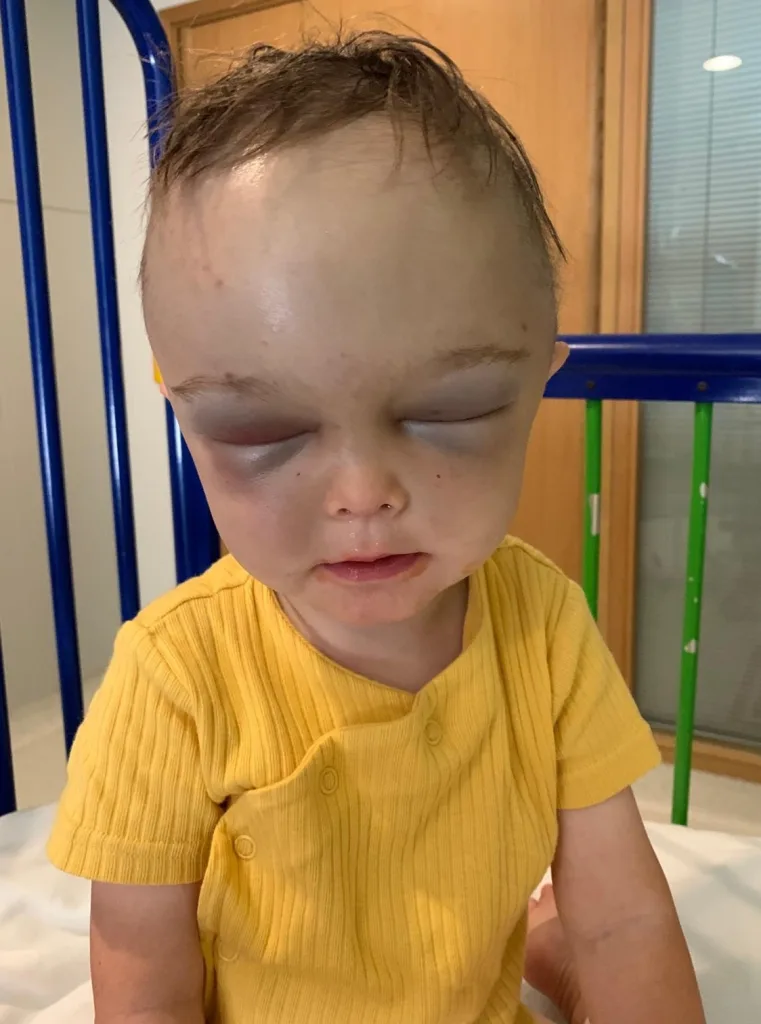 Mother shares ordeal after baby born with rugby ball-shaped head, diagnosed with craniosynostosis. Urges parents to seek answers and raise awareness.