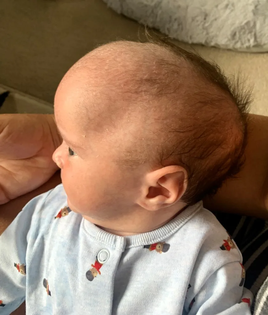 Mother shares ordeal after baby born with rugby ball-shaped head, diagnosed with craniosynostosis. Urges parents to seek answers and raise awareness.