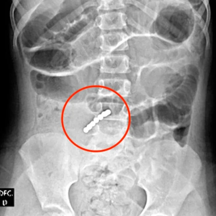 Girl, 6, turns up at A&E in agony after swallowing SEVEN magnets