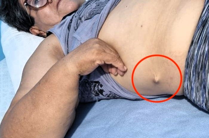 Woman spends six years in agony after doctors ‘leave tube inside her’