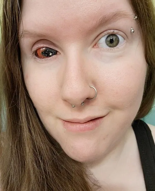 Woman shares her battle with eye pain due to Marfan Syndrome, ultimately leading to the removal of her eye to relieve excruciating pain. She now raises awareness and copes with prosthetic designs.