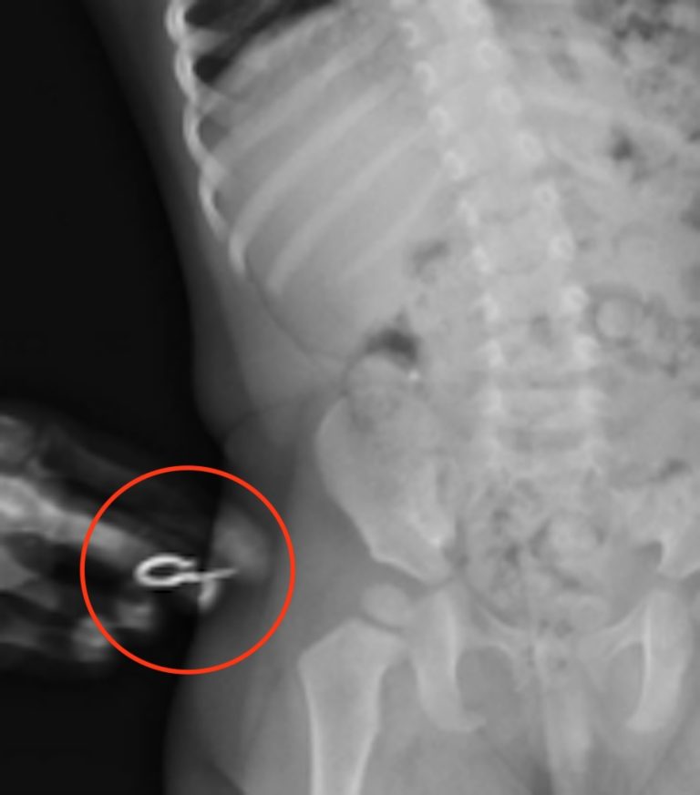 X Rayed Ear Doctors left baffled trying to find earring swallowed by a child in ...