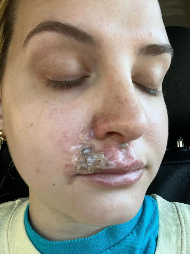 woman's excitement turned to horror after winning a free filler contest. Instead of fuller lips, she faced blistering and almost lost her upper lip. Medical intervention saved her, but the recovery was agonizing. Now, she shares her cautionary tale.