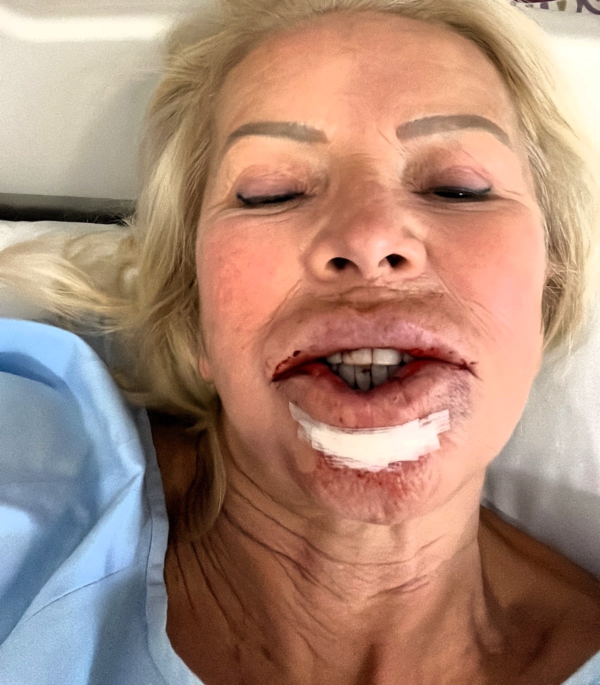 Woman's skin cancer ordeal after lip filler leads to tongue reconstruction; now, she raises awareness for skin cancer and lip filler risks