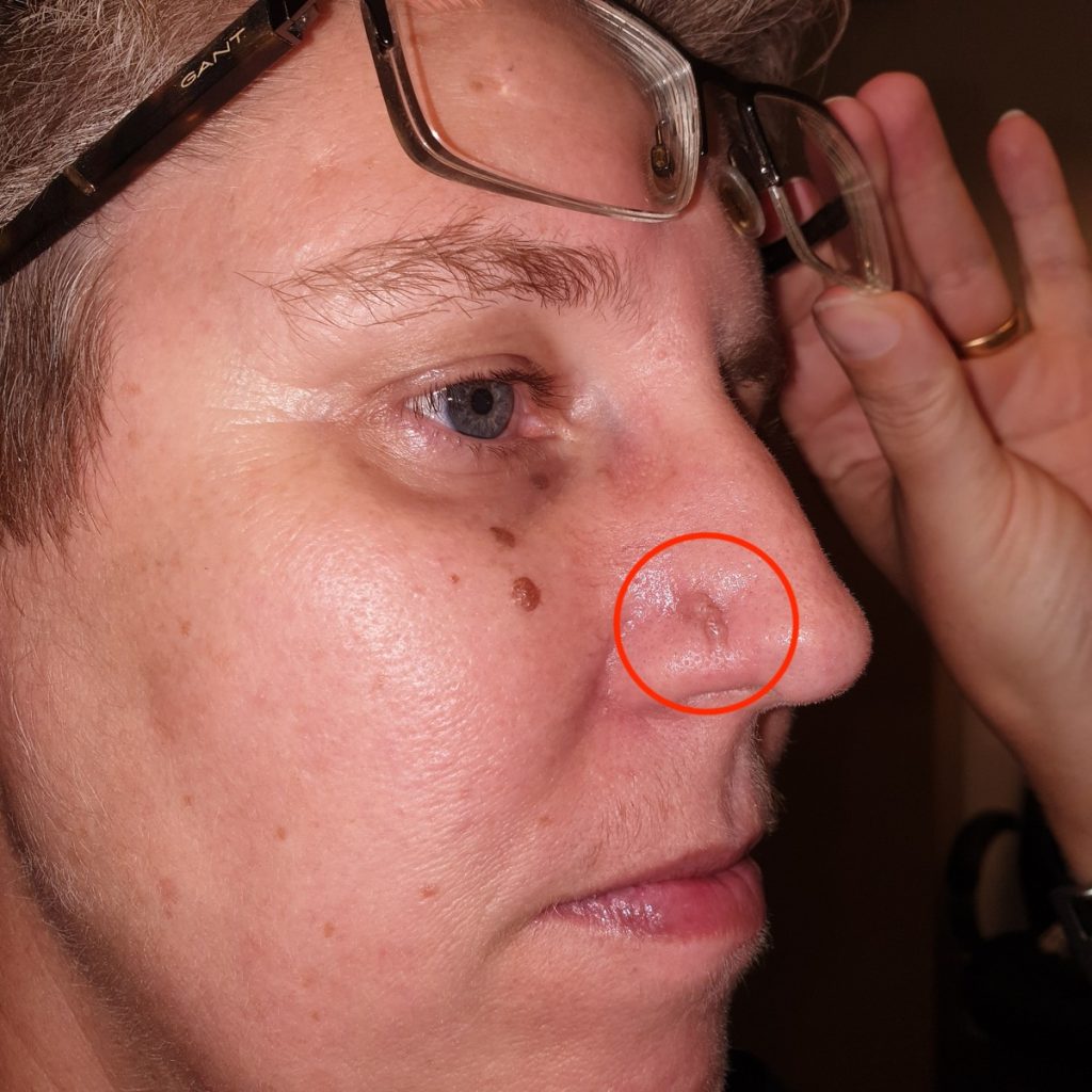 'I almost had my nose cut off as black growth took over – people need ...