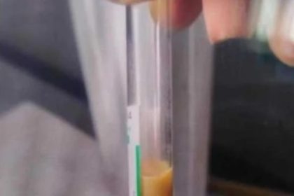Doctors stunned to find a patient's blood "half fat" due to extremely high lipid levels. Learn about the surprising causes and risks, even for those with a healthy weight.