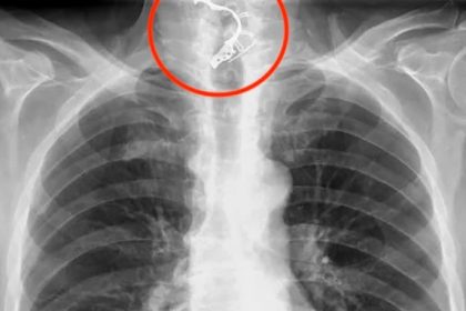 A 72-year-old man from Graz, Austria, was hospitalized after swallowing his dentures. Doctors used forceps to remove them, and he recovered smoothly after six days of alternative feeding.