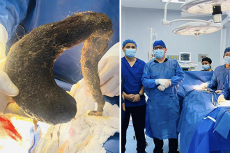 24-year-old woman with two-year tummy ache discovers 2lb hairball in her stomach. Successful 45-minute surgery in Ecuador removes the bezoar, saving her life.