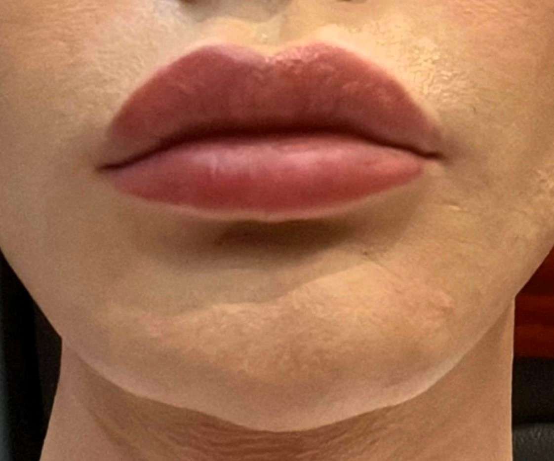 ‘Human Ken Doll’ Angelo Sanzio, who spent £109k on 25 surgeries, feared disfigurement after facial fillers left his chin in a mess. Recent surgery revealed severe complications.