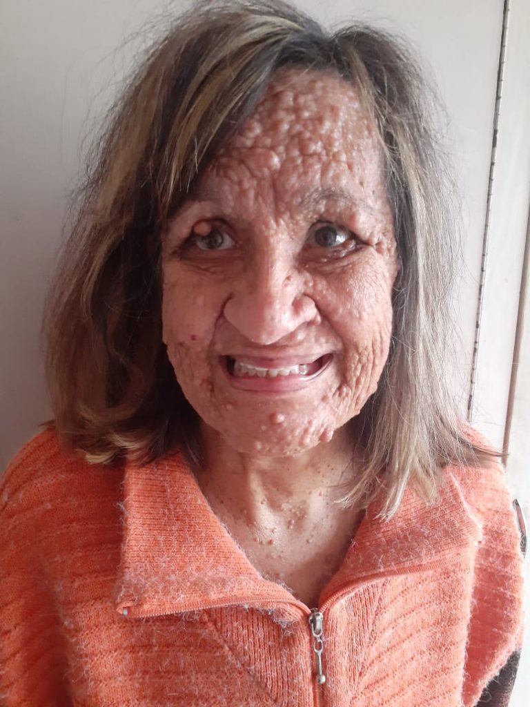A woman with a rare skin condition, often treated like a "leper," is undergoing transformative laser treatment on TV, restoring her confidence after decades of isolation.
