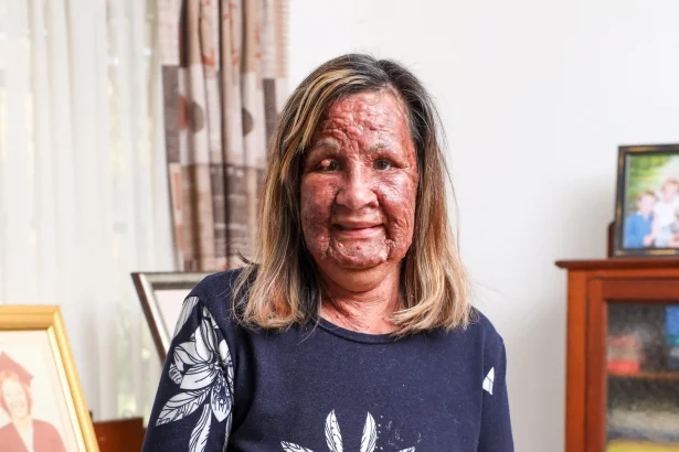 A woman with a rare skin condition, often treated like a "leper," is undergoing transformative laser treatment on TV, restoring her confidence after decades of isolation.