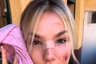 Influencer Isabel Busetto shows off cuts and bruises after an e-scooter accident in Rome, urging followers to ride carefully as e-scooter accidents continue to rise in Italy.