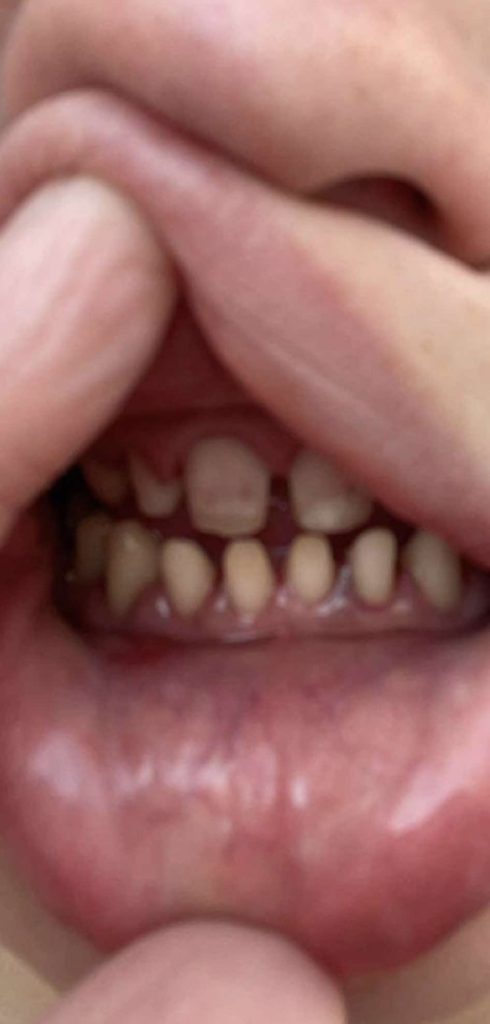 A woman warns others after botched dental surgery in Turkey left her toothless, facing a long recovery and thousands in additional costs to fix the failed treatment.