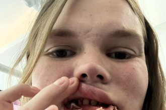 A woman warns others after botched dental surgery in Turkey left her toothless, facing a long recovery and thousands in additional costs to fix the failed treatment.