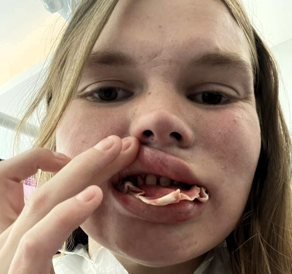 A woman warns others after botched dental surgery in Turkey left her toothless, facing a long recovery and thousands in additional costs to fix the failed treatment.