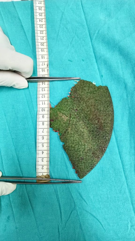 Labourer survives freak accident after machine blade embeds in his face. Surgeons in Ayodhya, India, perform a 4-hour operation to save his life and restore sight.