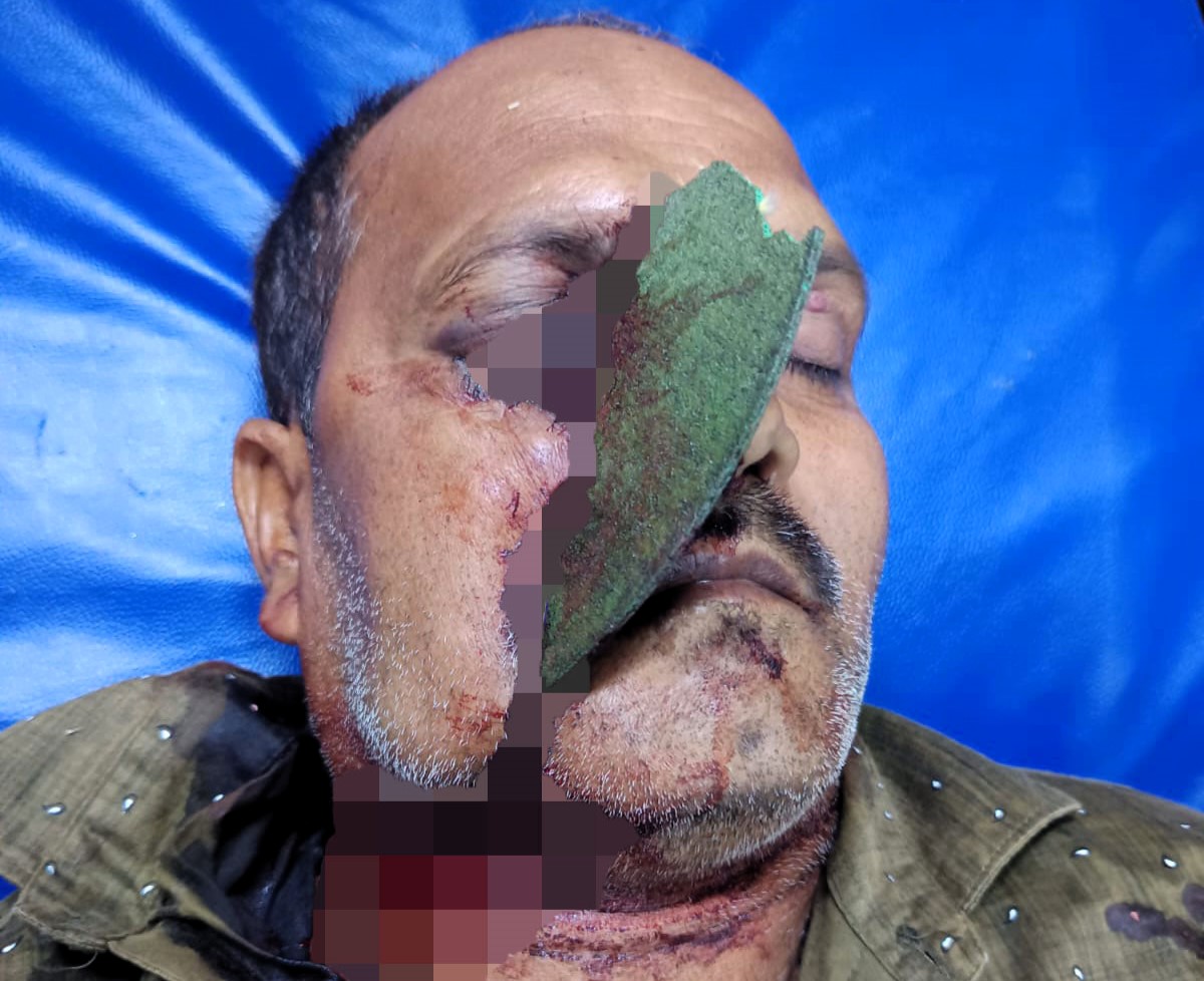 Labourer survives freak accident after machine blade embeds in his face. Surgeons in Ayodhya, India, perform a 4-hour operation to save his life and restore sight.