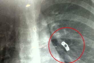 Influencer discovers metal spring in her lung after hospital visit for cold symptoms. Doctors suspect it traveled from past surgery, leaving her in shock but determined to stay positive.