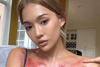 Model Sangyay Chen goes viral after sharing her gua sha routine, showcasing red marks from this ancient Chinese practice. Despite concerns, she highlights its healing benefits.