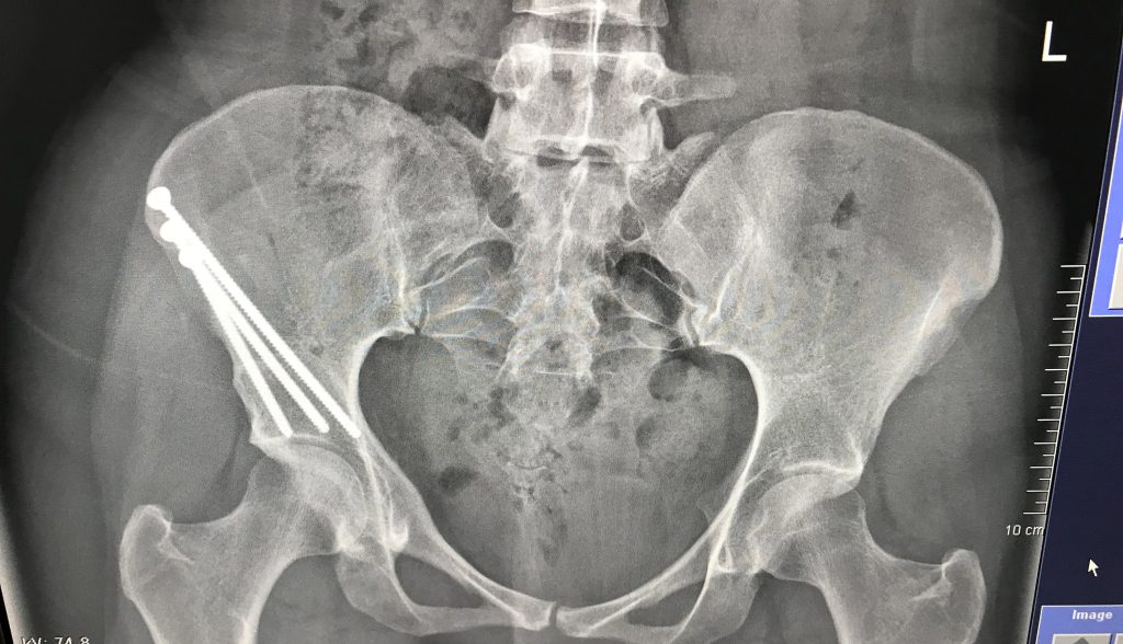 After years of debilitating hip pain, a woman finally found answers: hip dysplasia, hypermobility, and retroversion. Now, she’s urging others to push for proper care.