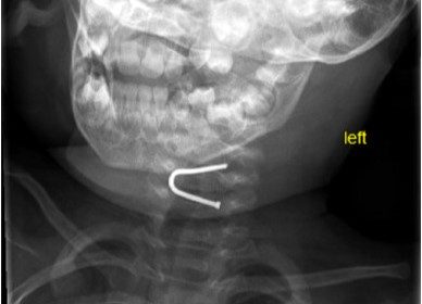 Doctors in New York removed a giant U-shaped nail from a 13-month-old baby’s throat after he swallowed it without showing any symptoms. Here's how they did it.