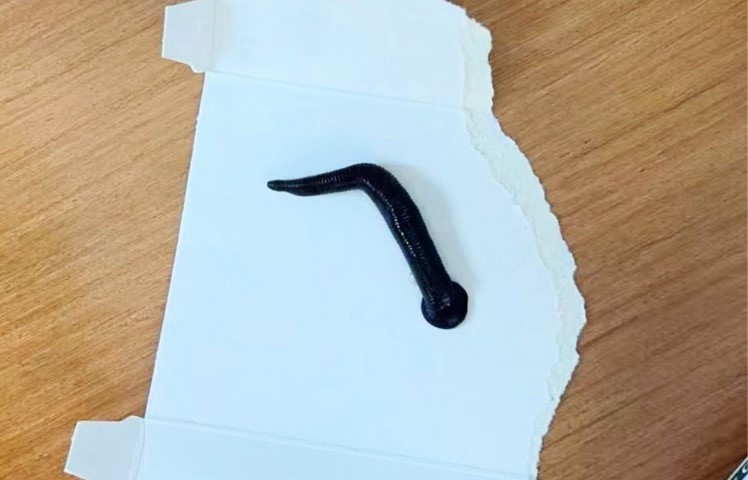 7-year-old boy in China coughs up a 12cm live leech, shocking doctors. The parasite caused serious infection but was successfully removed, restoring his health.