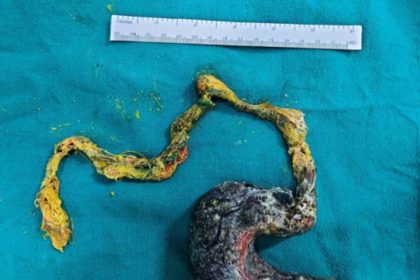 Doctors remove a giant hairball from a four-year-old girl with rare Rapunzel syndrome. The child’s condition highlights the dangers of untreated hair-eating disorders.