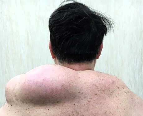 A man developed a rare ‘Saint Paulino tumour,’ a fatty mass on his shoulder, after carrying 50-60kg wooden spires during Italy’s Festa dei Gigli, a Catholic festival in Nola.