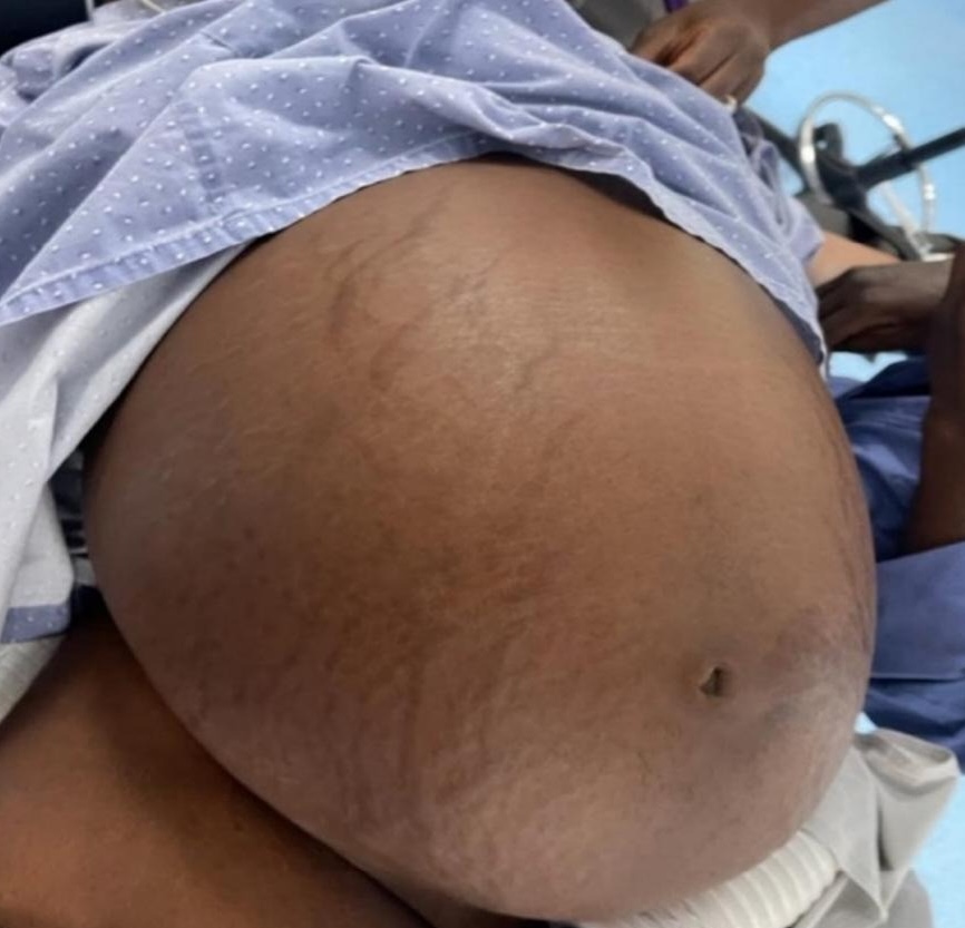 A 24-year-old woman in Ghana underwent surgery to remove a record-breaking 50cm ovarian cyst holding 24 litres of fluid, marking the country’s first case of its kind.