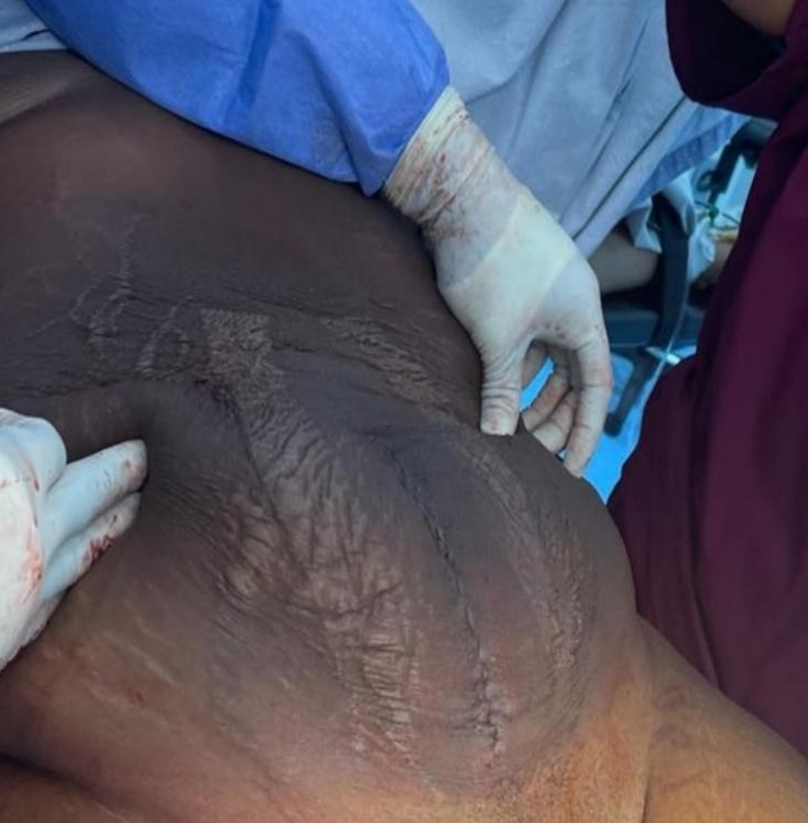 A 24-year-old woman in Ghana underwent surgery to remove a record-breaking 50cm ovarian cyst holding 24 litres of fluid, marking the country’s first case of its kind.