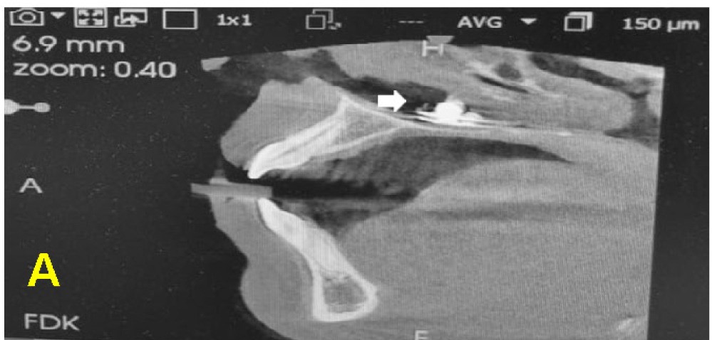 A 17-year-old boy was shocked to learn a metal button had been stuck in his nose for over a decade – only discovered during a routine dental X-ray.
