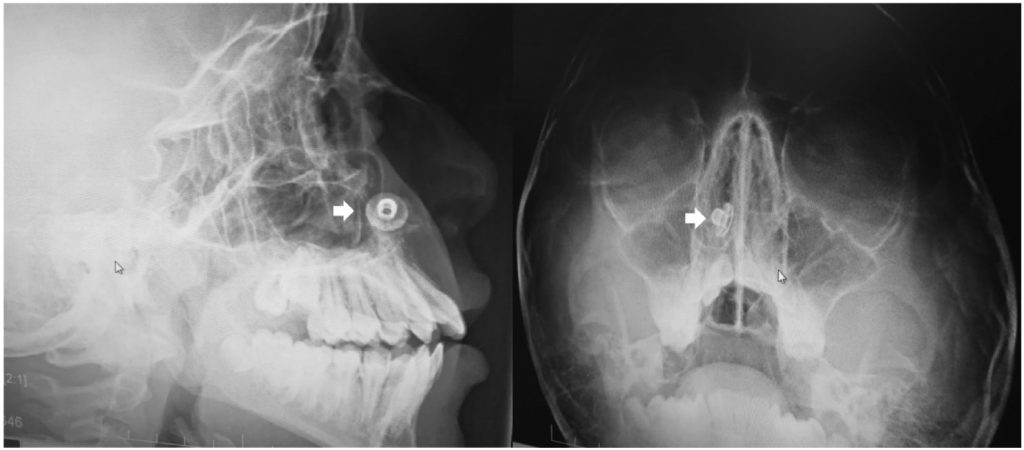 A 17-year-old boy was shocked to learn a metal button had been stuck in his nose for over a decade – only discovered during a routine dental X-ray.