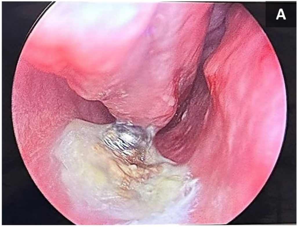 A 17-year-old boy was shocked to learn a metal button had been stuck in his nose for over a decade – only discovered during a routine dental X-ray.