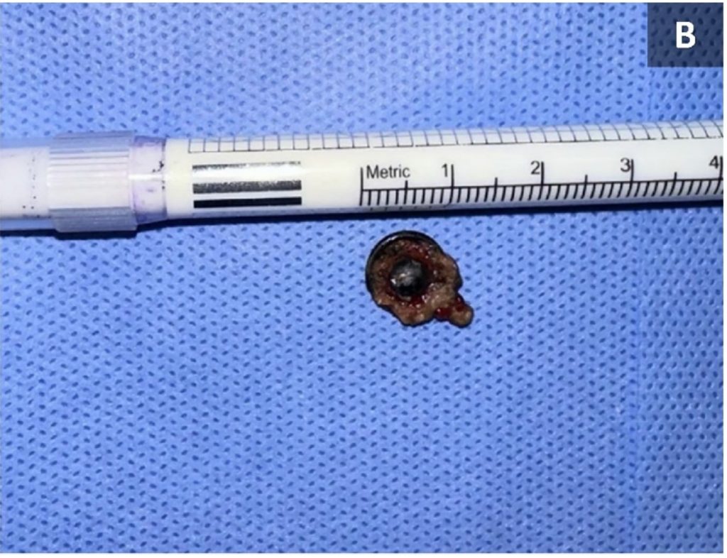 A 17-year-old boy was shocked to learn a metal button had been stuck in his nose for over a decade – only discovered during a routine dental X-ray.