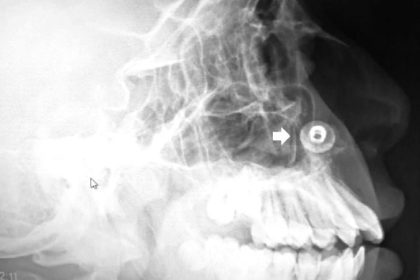 A 17-year-old boy was shocked to learn a metal button had been stuck in his nose for over a decade – only discovered during a routine dental X-ray.