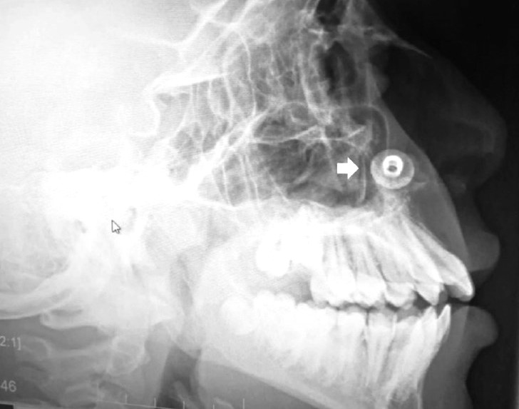A 17-year-old boy was shocked to learn a metal button had been stuck in his nose for over a decade – only discovered during a routine dental X-ray.