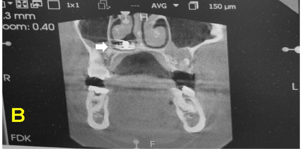 A 17-year-old boy was shocked to learn a metal button had been stuck in his nose for over a decade – only discovered during a routine dental X-ray.