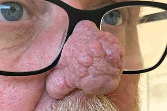 A man who avoided public life due to a severe skin condition found hope after private surgery restored his confidence, allowing him to embrace life once more.