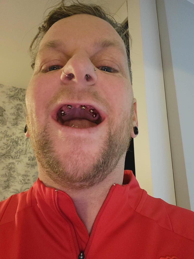 Hooked on energy drinks, a UK man lost multiple teeth and flew to Turkey for a £9K smile makeover. Now confident and warning others, he’s ditched the cans for good.