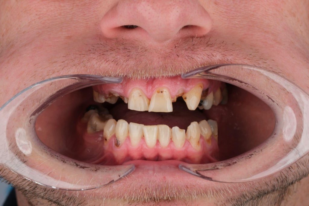 Hooked on energy drinks, a UK man lost multiple teeth and flew to Turkey for a £9K smile makeover. Now confident and warning others, he’s ditched the cans for good.