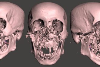 A fisherman in Thailand survived a brutal Asiatic black bear attack that left him nearly unrecognisable, with surgeons using complex reconstruction to restore his face.