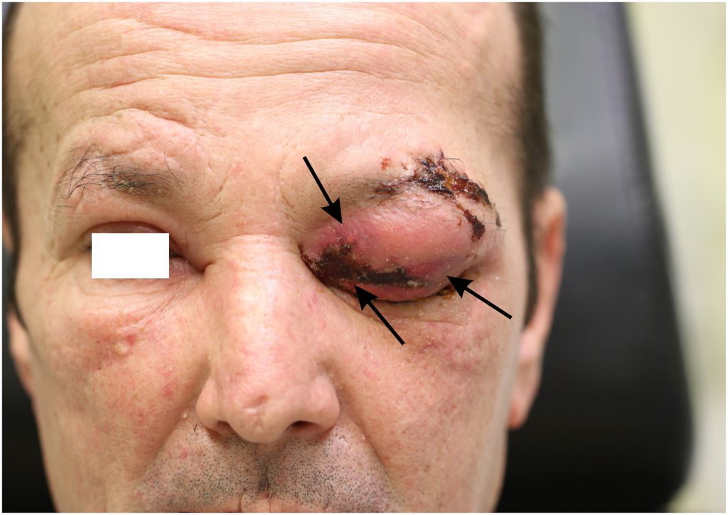 A rare flesh-eating infection left three men with swollen eyelids, with one tragically dying, as doctors emphasize early aggressive treatment to prevent fatal outcomes.