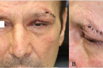 A rare flesh-eating infection left three men with swollen eyelids, with one tragically dying, as doctors emphasize early aggressive treatment to prevent fatal outcomes.